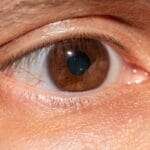 Zapalenie rogówki wywołane przez Acanthamoeba – dlaczego woda z kranu jest groźna dla soczewek?