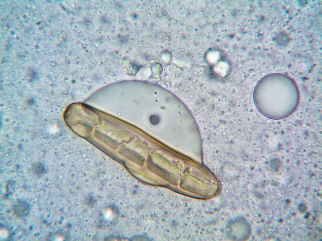 Zapalenie rogówki wywołane przez Acanthamoeba – dlaczego woda z kranu jest groźna dla soczewek?