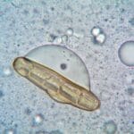 Zapalenie rogówki wywołane przez Acanthamoeba – dlaczego woda z kranu jest groźna dla soczewek?